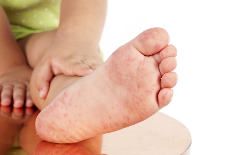 Hand, Foot And Mouth Disease ( HFMD ) Health Insure Savvy