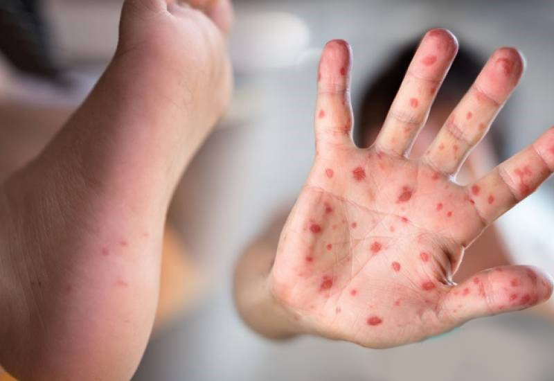 https://health.insuresavvy.com.my/wp-content/uploads/2018/07/Hand_Foot_And_Mouth_Disease_7-1.jpg