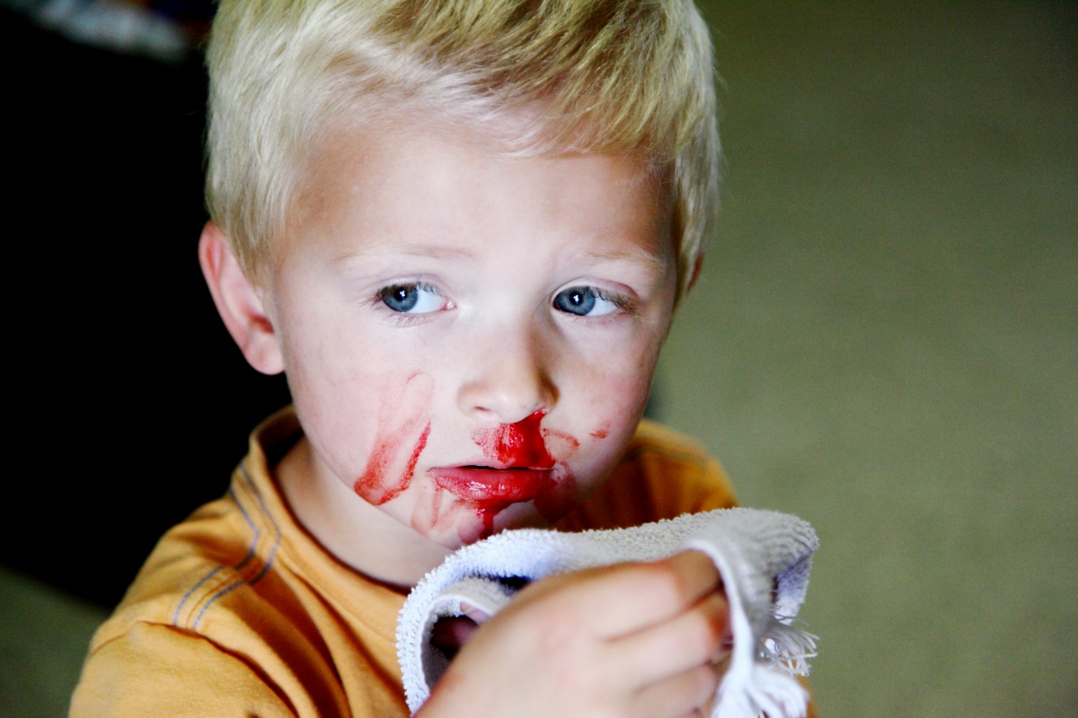 What causes nose bleeding deals in children