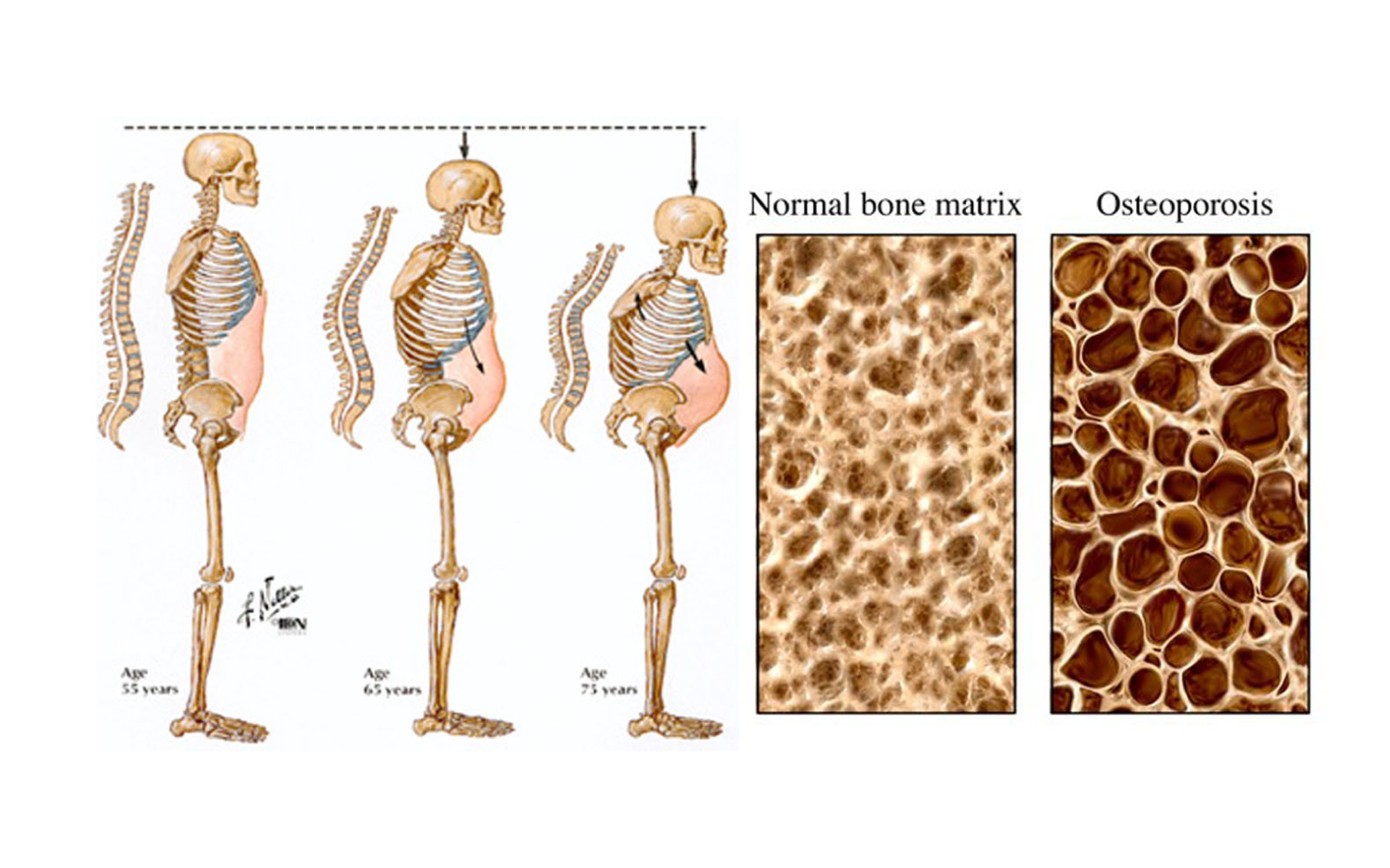 Osteoporosis maksud